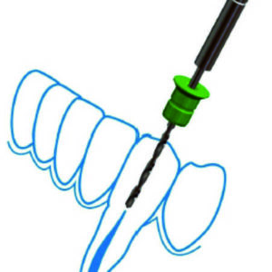 STECO GUIDE<br># Endodoncia guiada #